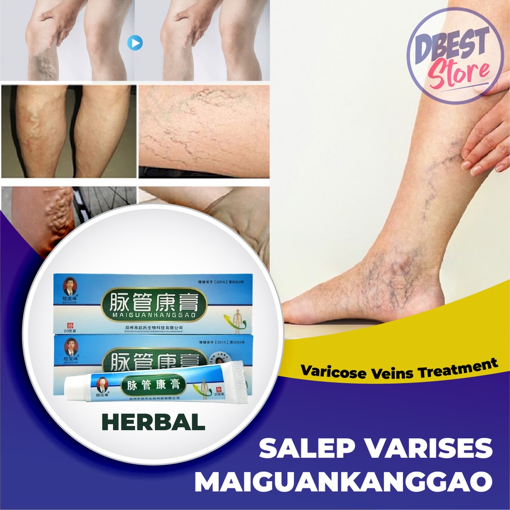 Salep Krim Varises Herbal Maiguankanggao - Varicose Veins Treatment
