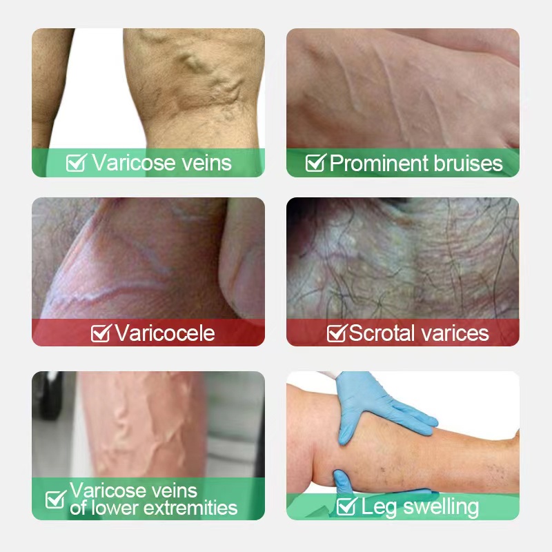 Obat Varises Salep Varises Cream Varicose Veins Varikokel Bengkak Benjolan Buah Zakar Nyeri Testis Vaskulitis Flebitis Pengobatan Vaskulitis Salep