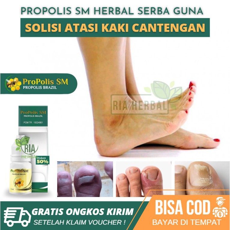 Obat Telapak Kaki Luka Gangren, Rangen Rorombeheun Pitted Keratolysis Pengobatan Tinea Pedis Salep
