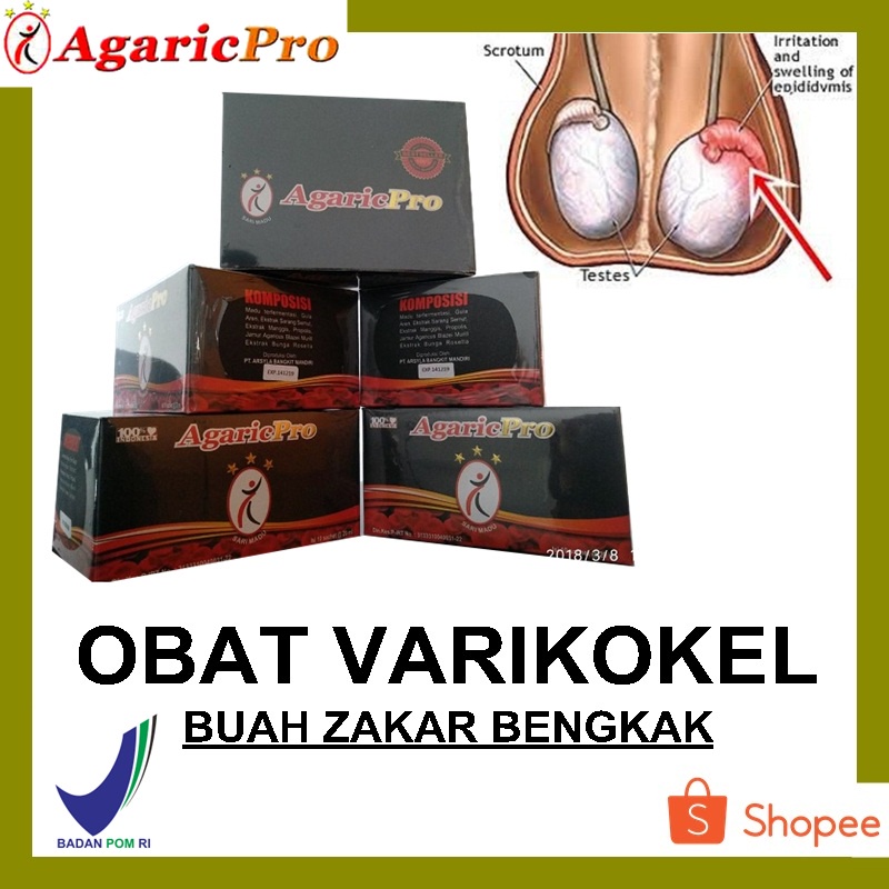 Obat Varikokel Untuk Mengempiskan Buah Zakar Bengkak Secara Alami