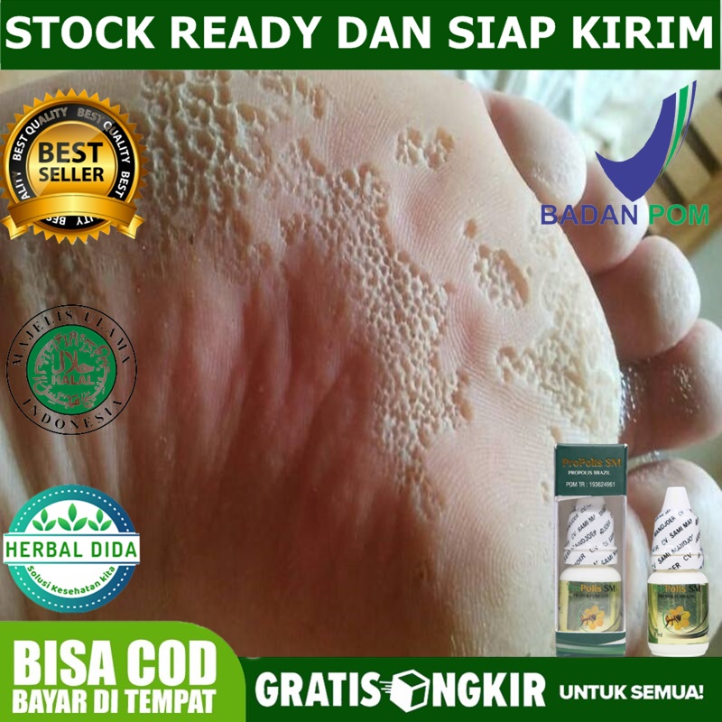 Obat Kaki Rayapan Herbal, Obat Kaki Rayapan dan Bau, Obat Penghilang Kaki Rayapan, Obat herbal Telap
