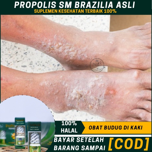 Obat Budugan, Budug Bernanah, Gatal, Menghilangkan Budug, Budugan, Borok, Obat Herbal Penyakit Budug