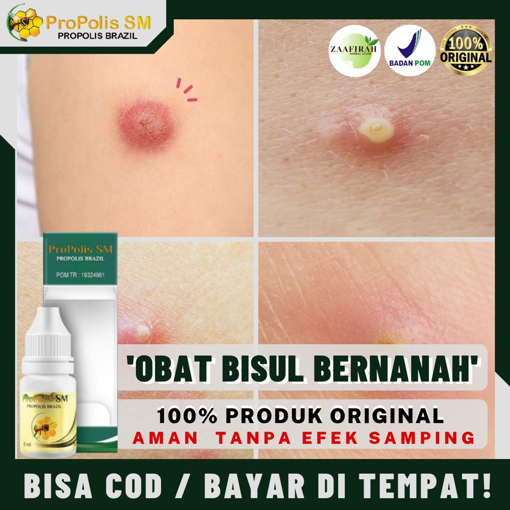 Obat Bisul Obat Bisul Di Pantat Obat Bisul Bernanah Obat Oles Bisul Obat Salep Bisul Obat Bisul Kela