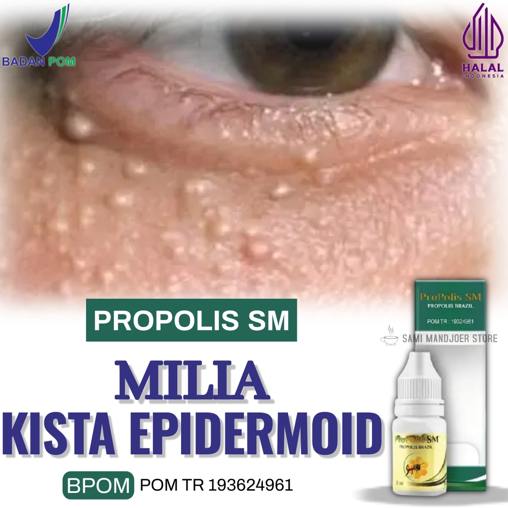 Cream Obat Milia,Mengempiskan Milia PROPOLIS SM BUKAN MELIA