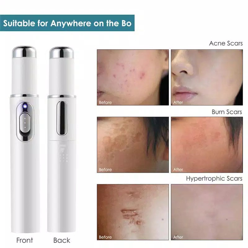 Acne Laser Pen Facial Massager Treatment Soft Scar