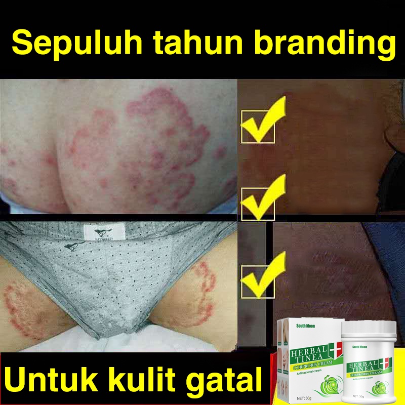 Salep gatal Salep Eksim Salep kulit Krim psoriasis paling ampuh Kulit Kepala Psoriasis Tangan Tinea Kaki Bau Versicolor Menghambat Dermatitis Jamur Anti Gatal Cream 30G