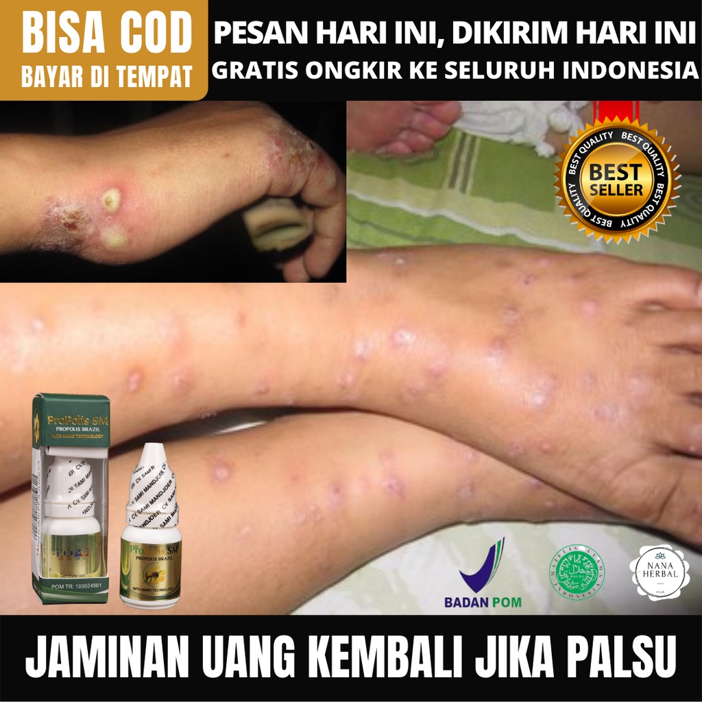 Obat Borok Budug Bernanah - Obat Budug Santri - Obat Cenang Bernanah - Obat Luka Bernanah - Obat Bor