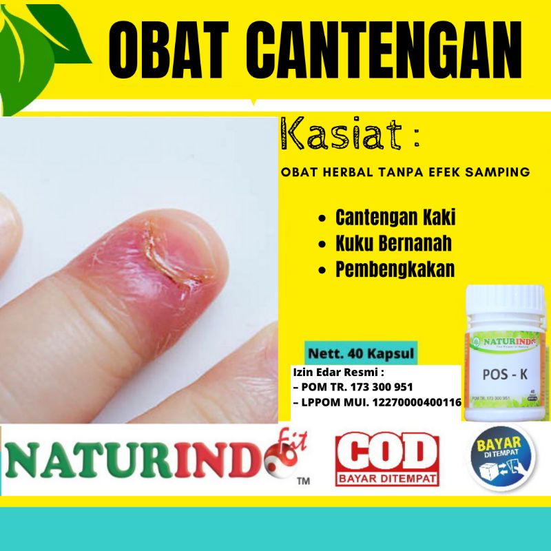 Obat Cantengan Ampuh -Obat Cantengan Jempol Kaki Di Jari Bernanah Bengkak