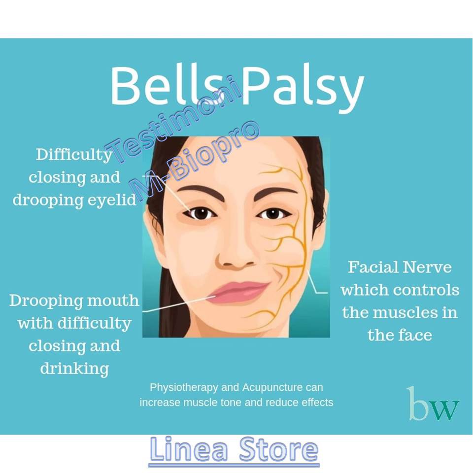 Apa Itu Bells Palsy