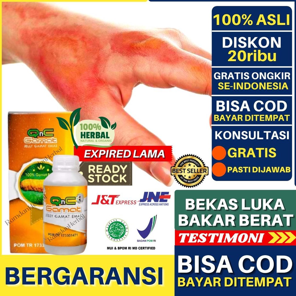 Jual Obat Penghilang Bekas Luka Bakar Berat Pengering Luka Bakar Penghilang Luka Bakar