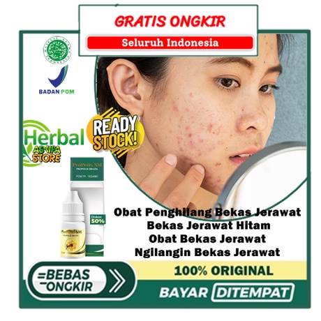 Obat Penghilang Bekas Jerawat, Bekas Jerawat Hitam, Obat Bekas Jerawat, Ngilangin Bekas Jerawat, Fle