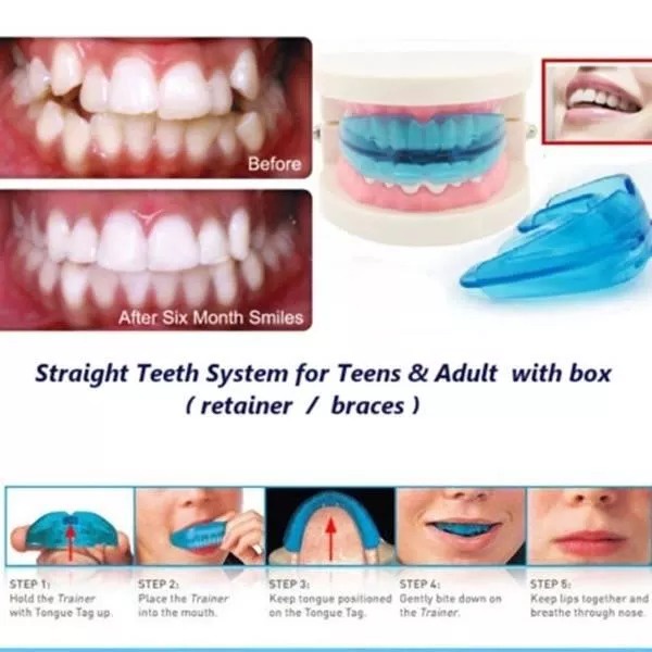 Orthodontic Trainer Perapi Gigi Pengganti Behel Dewasa - Alat Perapi Gigi Tanpa Behel Ortho Trainer Alignment Biru