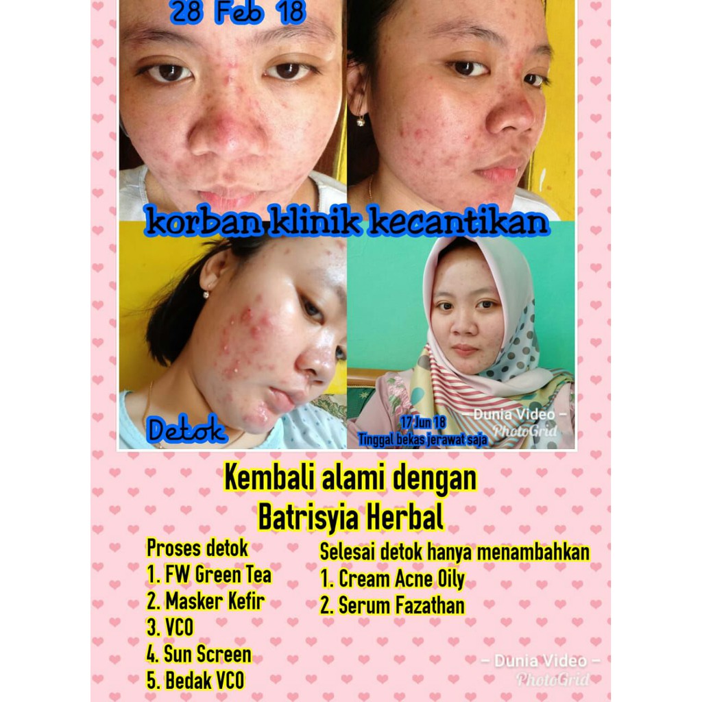 Batrisyia Herbal Serum Anti Acne 20 ml (Fazathan Serum)