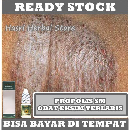 Obat Oles Eksim Kering - Salep Eksim - Obat Exim - Obat Eksim basah - Obat Eksim Parah - Eksim Kering Basah - Kering Menahun - Obat Eksim Gatal - Kurap - Panu - Psoriasis - Koreng Dengan Herbal Propolis SM Asli 100% Original Tanpa Efek Samping Apapun