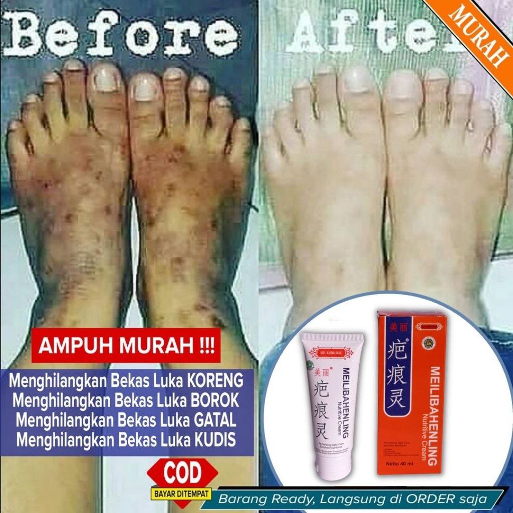 Meilibahenling Original 100% Obat Cream Penghilang Bekas Luka Lama Hitam Koreng Bopeng Ampuh BPOM Resmi Mengobati Luka Kulit Asli Halal Berkhasiat Untuk Menghilangkan Semua Jenis Bekas Luka Yang Mengandung Bahan Natural Alami Tanpa Efek Samping BIO HERBAL