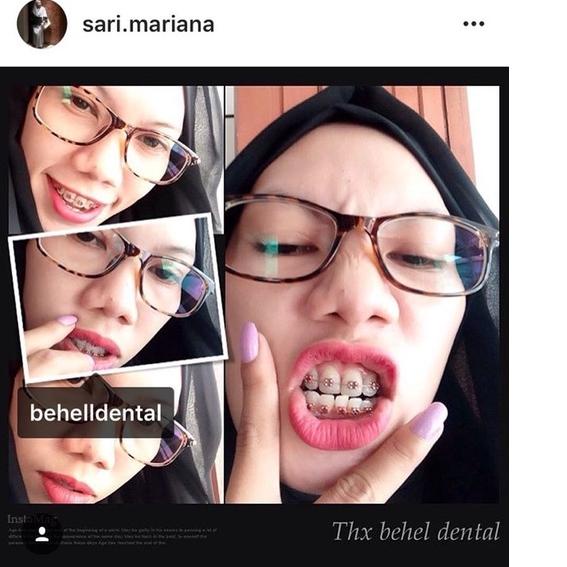 Special ORIGINAL BRACKET BEHEL METAL ORTHO FDA / AEGIS / GEOUSIS / LUXURY MINI ROTH MENGKILAP WITH H