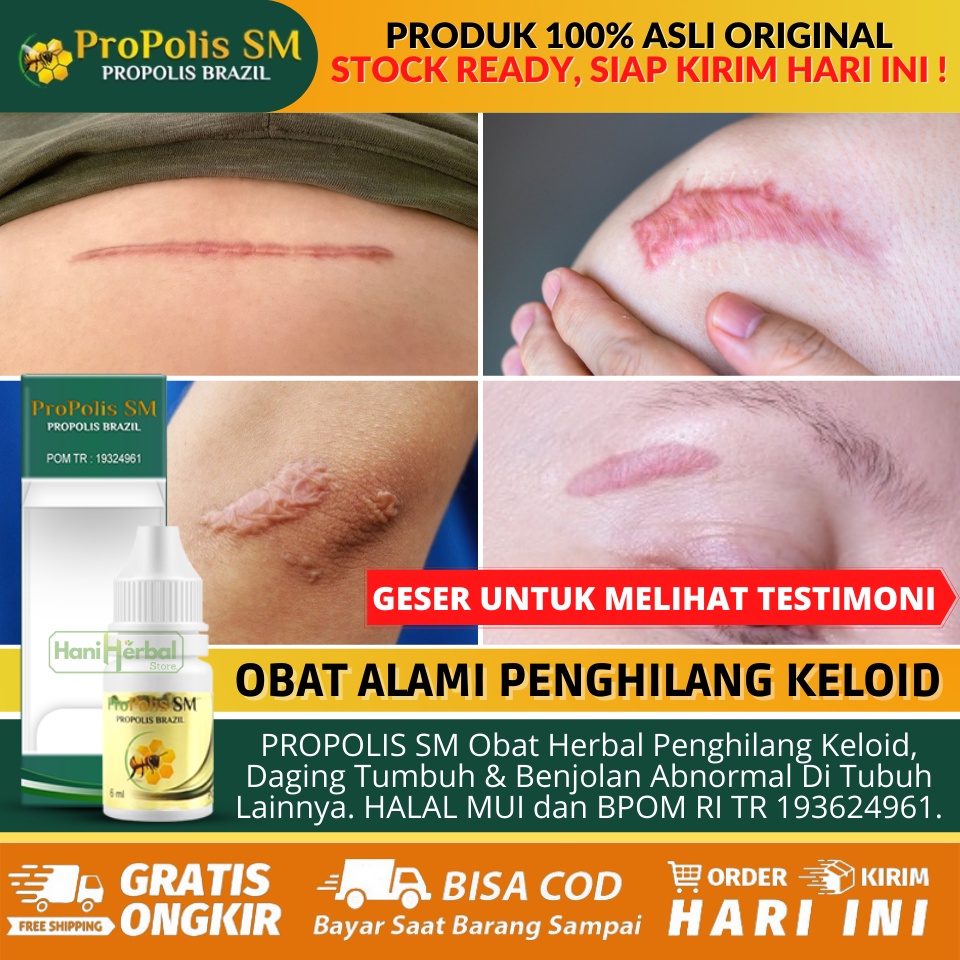 Obat Penghilang Keloid 100% Alami Asli, Obat Untuk Keloid, Obat Penghilang Daging Tumbuh / Daging Ja
