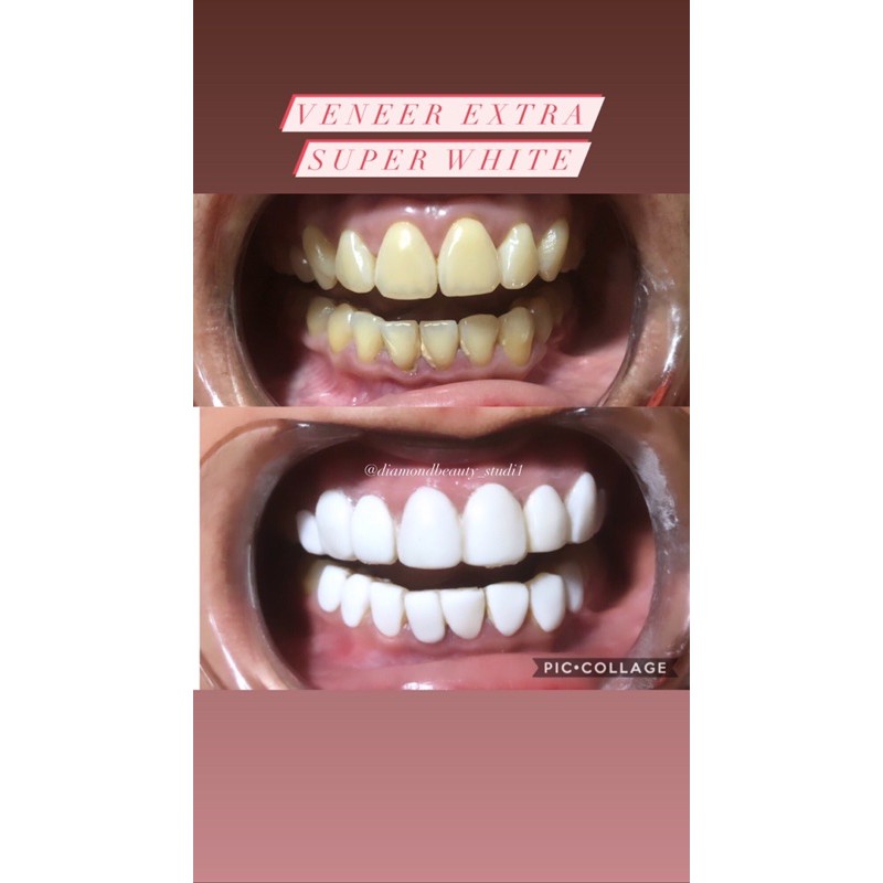 

Veneer Extra Super White