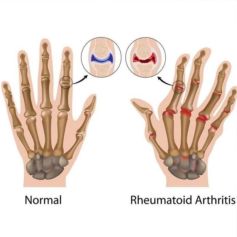 TD-DPR SAFEBET Sarung Tangan Terapi Arthritis Glove Therapy Size M - AY337