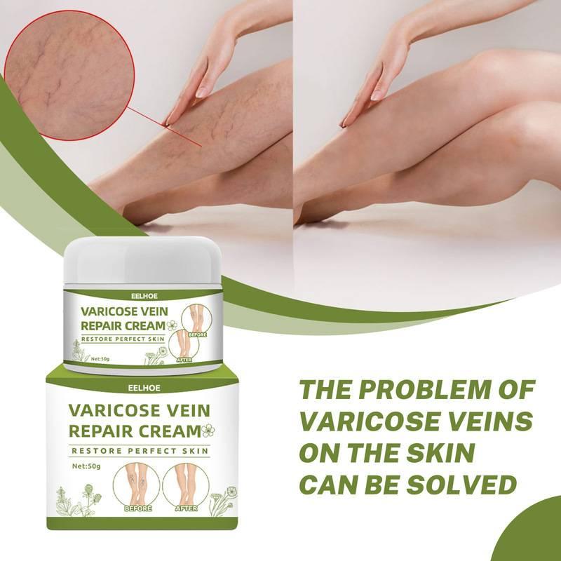 Obat Varises Salep Varises Cream Varicose Veins Varikokel Bengkak Benjolan Buah Zakar Nyeri Testis Vaskulitis Flebitis Pengobatan Vaskulitis Salep