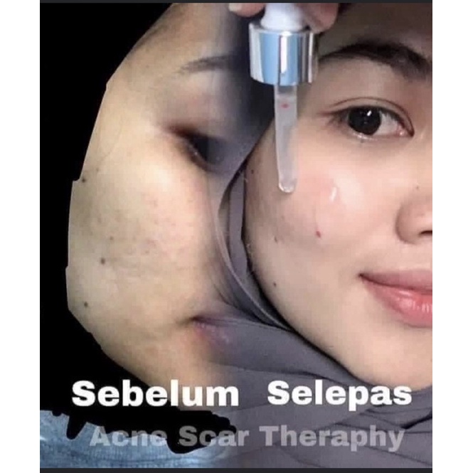 NURFELLA BEAUTY ACNE SCARS ORIGINAL MALAYSIA