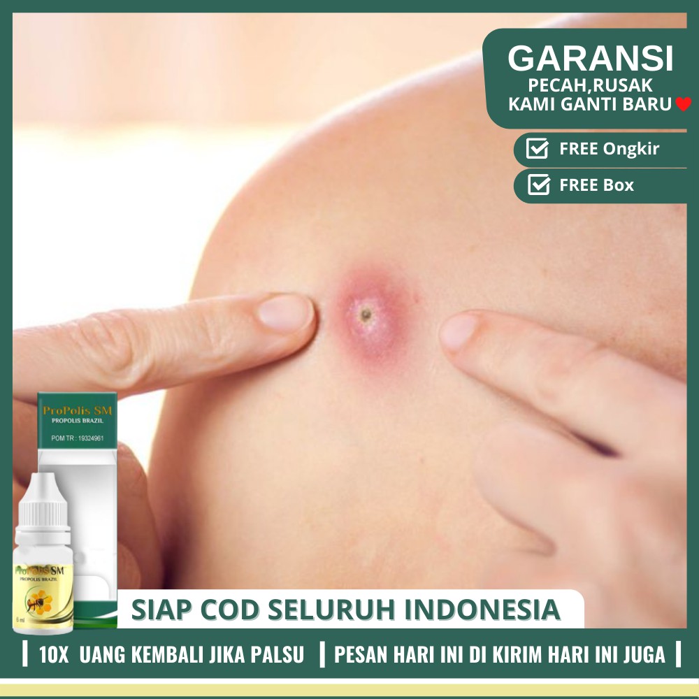 Obat Penangkal Bisul (Abses) - Obat Benjolan Bisul Di Pantat, Bokong & Kemaluan [COD]