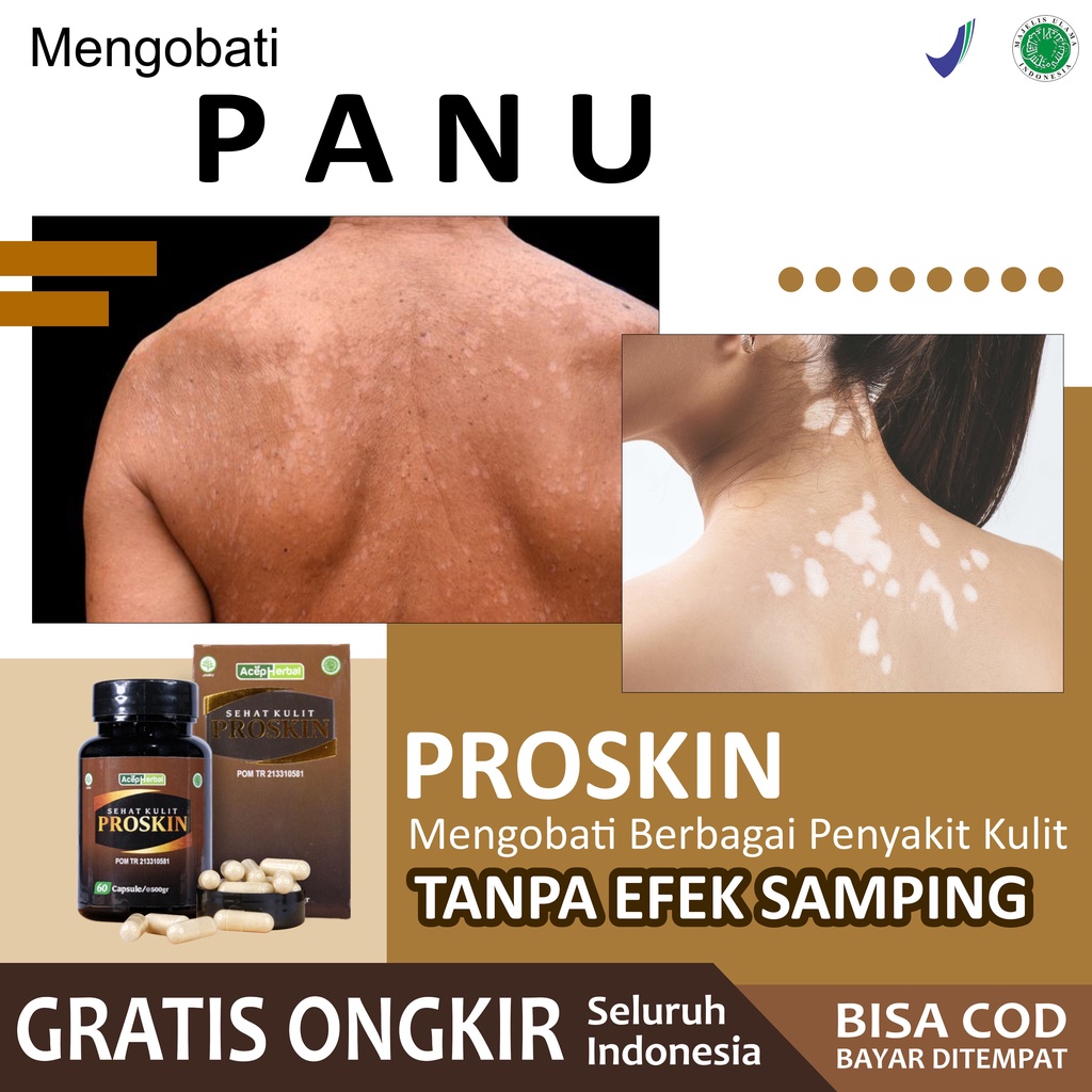 Obat Panu di Wajah Pipi Punggung Tangan Muka Badan Anak dan Dewasa Menahun Gatal Jamur Hapur Bercak 