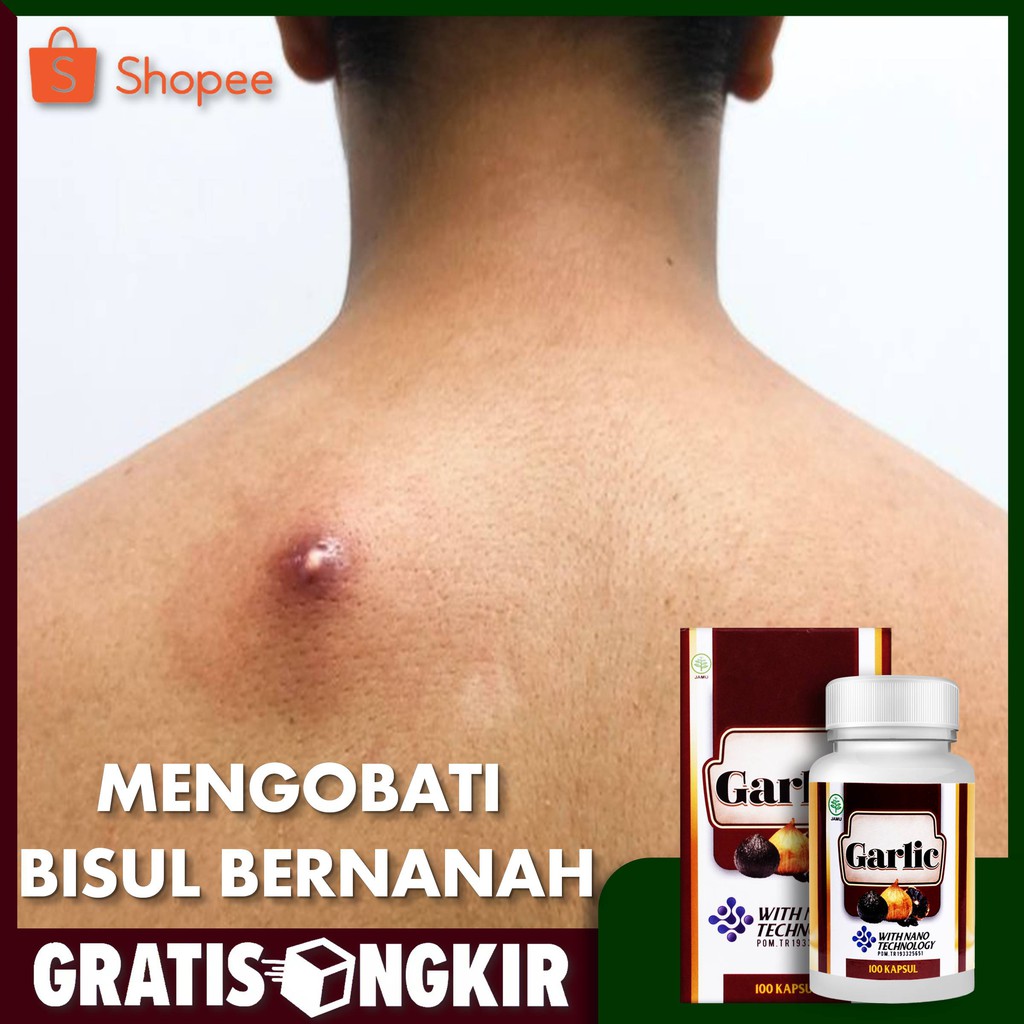 Walatra Black Garlic Kapsul Obat Herbal Bisul Bernanah Bisul Menahun Dapat Mengatasi Berbagai Bisul