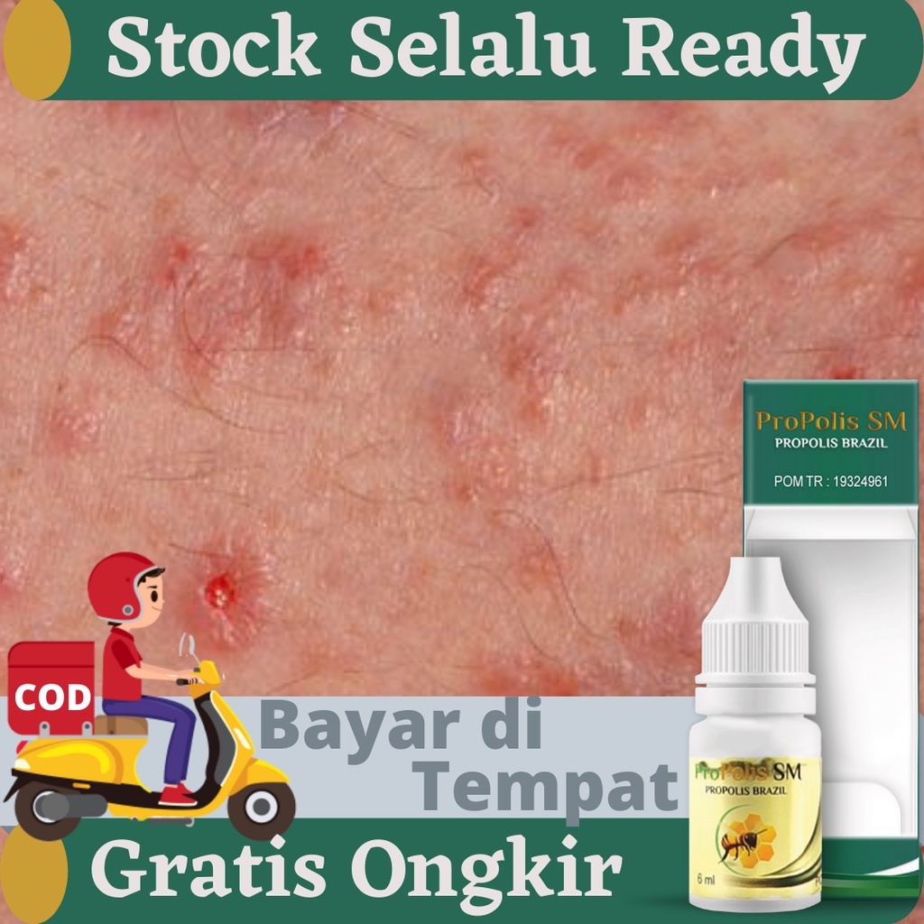 Jual Obat Kudis Kurap Gatal Yang Bagus & Aman Untuk Anak & Dewasa ...