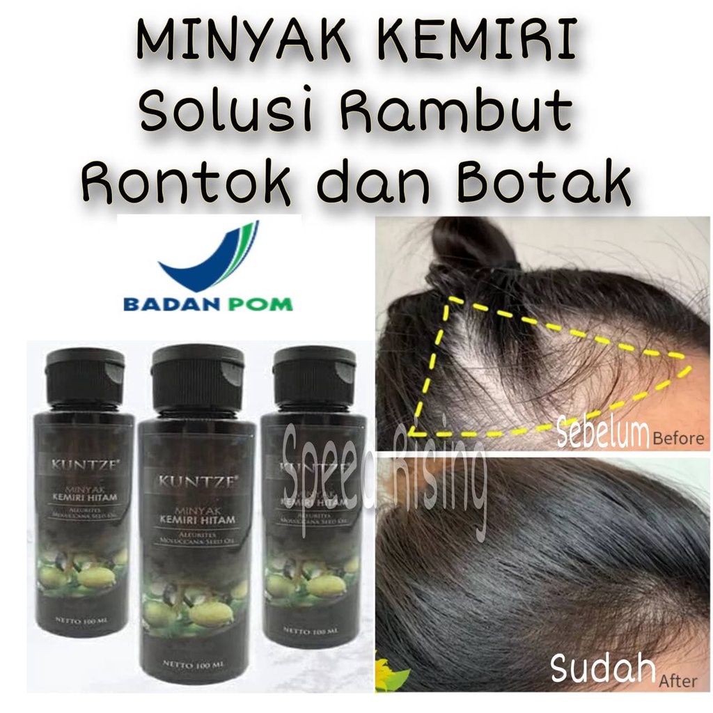 Minyak Kemiri Penumbuh Rambut Botak Minyak Kemiri Kuntze BPOM Original Minyak Kemiri Penyubur Rambut Rontok Minyak Kemiri Penghitam Rambut Penumbuh Rambut Ampuh Shampoo Metal Penumbuh Rambut Sampo Penumbuh Rambut Obat Penumbuh Rambut Obat Kebotakan