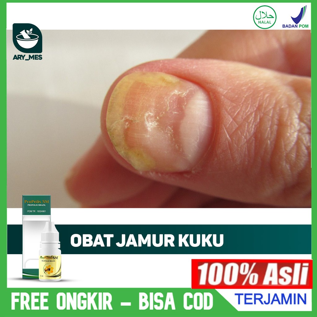 Obat Jamur Kuku tangan dan Kaki - Kuku Rusak Bergelombang, Jamuran, Busuk Propolis SM ORIGINAL ASLI