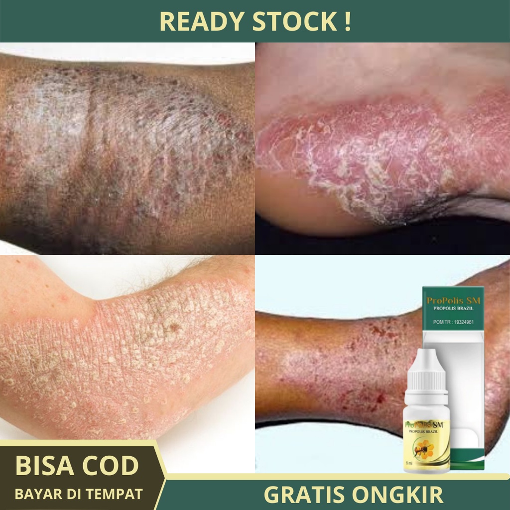 Obat Eksim, Eksim Kering, Eksim Basah, Salep Eksim, Eksim Di Kaki Dan Tangan, Eksim Menahun,  Gatal 