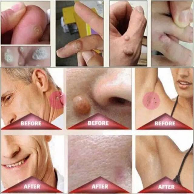 Skin Tag Remover penghilang kutil tahi lalat