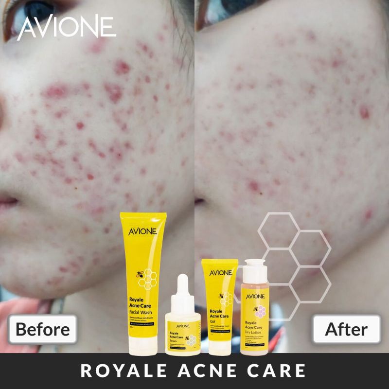 Avione Royale Acne Care - Facial Foam |Dry Lotion | Serum |Gel (Moisturizer)