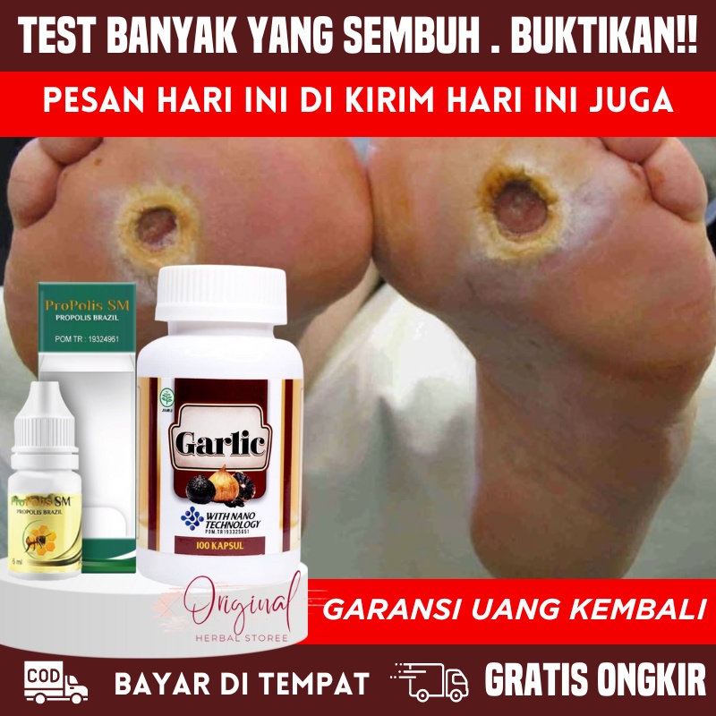 Obat Diabetes, Obat Luka diabetes, Obat herbal diabetes, Obat diabet, Salep luka diabetes, Obat diab