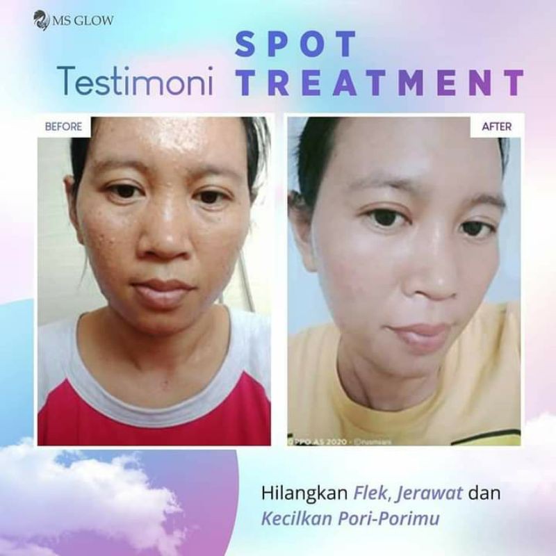 Paket wajah acne ms glow/jerawat/bopeng