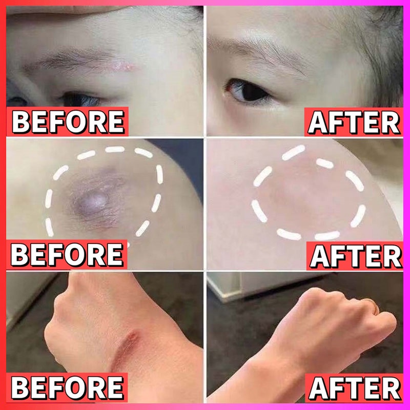 【Barang spot】cream penghilang bekas luka jerawat hitam koreng menghilangkan bekas jerawat sabun penghilang bekas luka serum penghilang bekas jerawat dermatik penghilang bekas luka salep bekas luka obat menghilangkan bekas luka