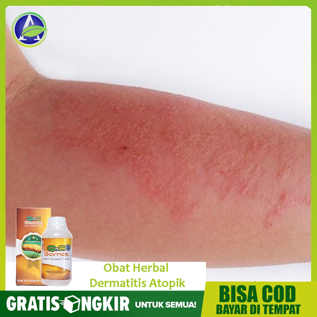 Obat Herbal Dermatitis Atopik, Eksim Atopik, Gatal di Kulit QnC Jelly Gamat ASLI - HALAL - Bisa COD