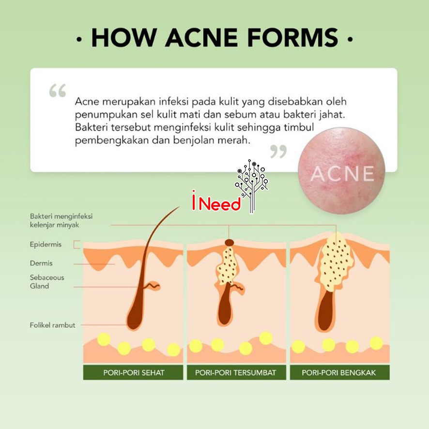 (INEED) YOU AcnePlus Triple Action Spot Care 15gr Gel Jerawat - Acne Spot Gel