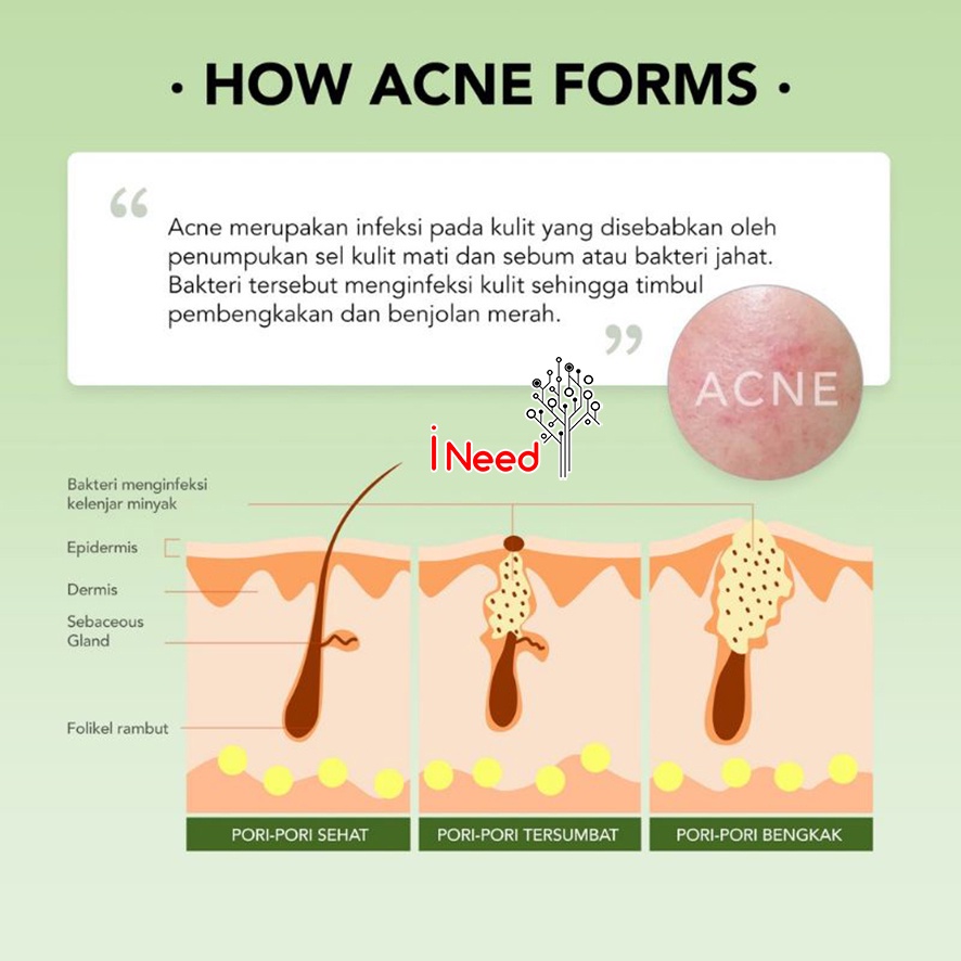 (INEED) YOU AcnePlus Triple Action Spot Care 15gr Gel Jerawat - Acne Spot Gel