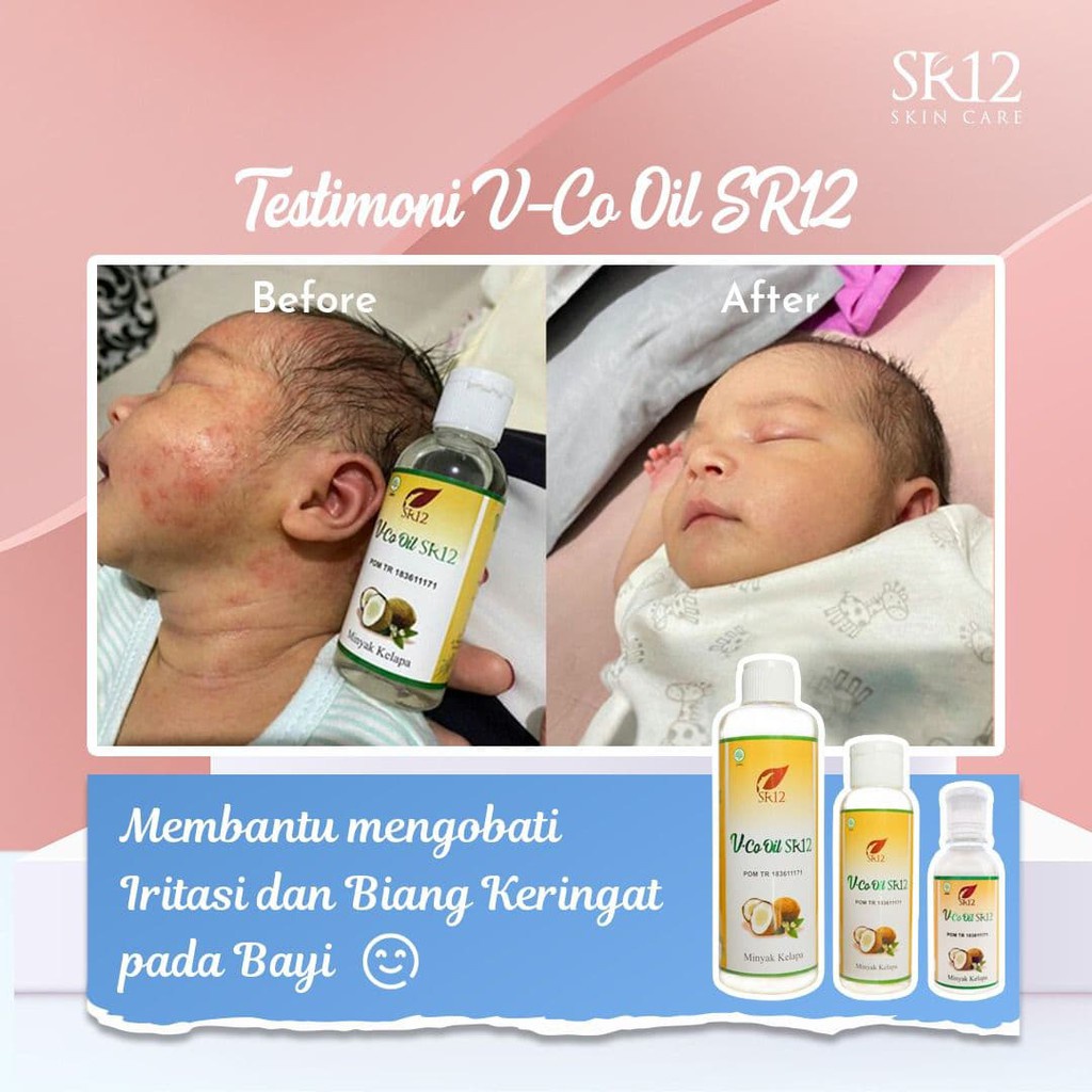 Vco Virgin Coconut Oil Untuk Ruam Popok Bayi Bruntusan Eksim Menghilangkan  Cradle Cap Treatment Baby Lemak Tambahan Mpasi