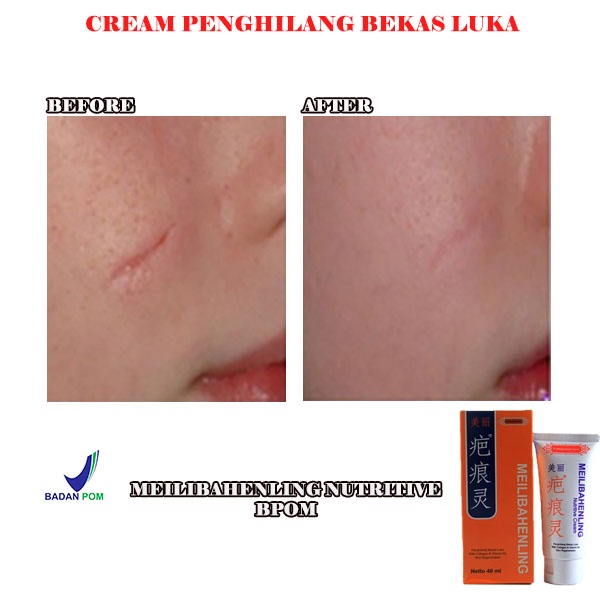 MEILIBAHENLING NUTRITIVE BPOM penghilang bekas luka CREAM MEILIBAHENLING ORIGINAL