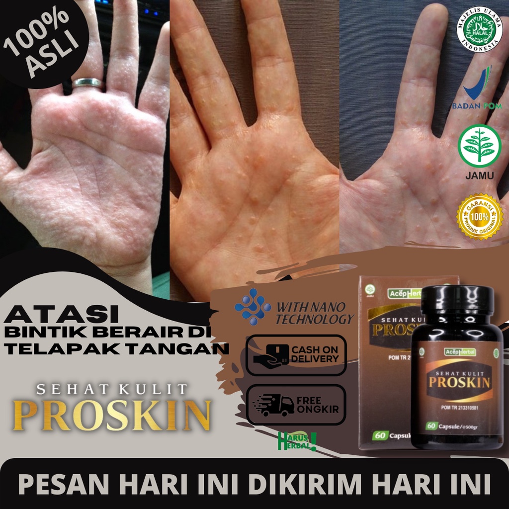 Obat Penghilang Gatal & Bintik Berair Di Telapak Tangan, Obat Bentol Berair, Telapak Tangan Gatal Bi