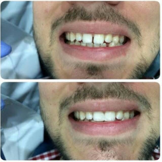 Teeth trainer /perapi gigi