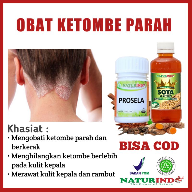 Obat ketombe Parah Paling Ampuh Obat Ketombe Berkerak Obat Ketombe Rambut Obat  Ketombe Kering Obat 