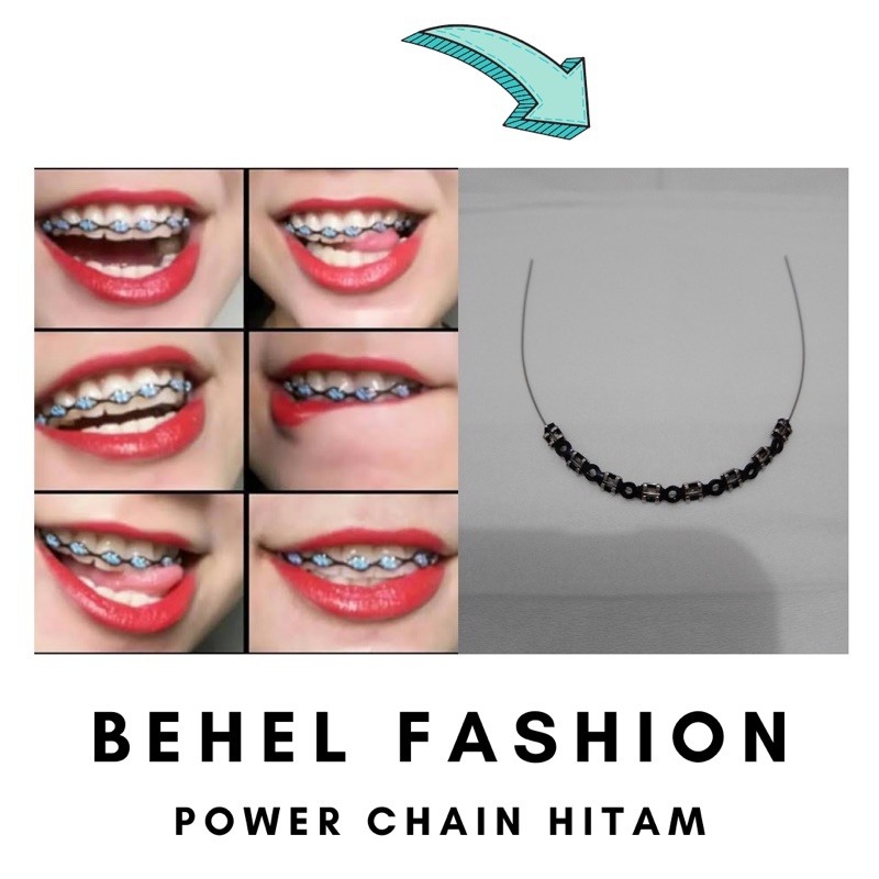 [Bisa COD] Behel Fashion Lepas Pasang Model Power Chain Warna Hitam Hanya Atas saja / Bawah saja