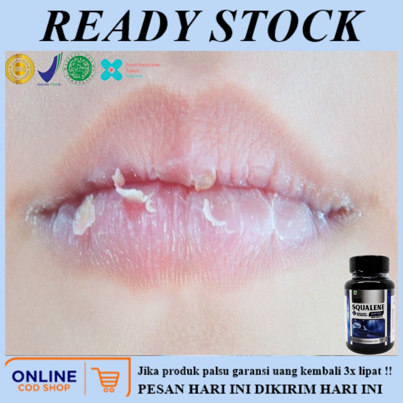 Obat bibir pecah pecah, Obat bibir pecah dan kering, Obat bibir kering dan hitam, Obat bibir pecah a