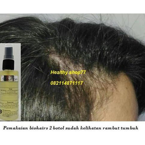 476G84Y7-Terlaris-Sale-- Bio Hair - Biohairs Solution - Serum Penumbuh Rambut Botak