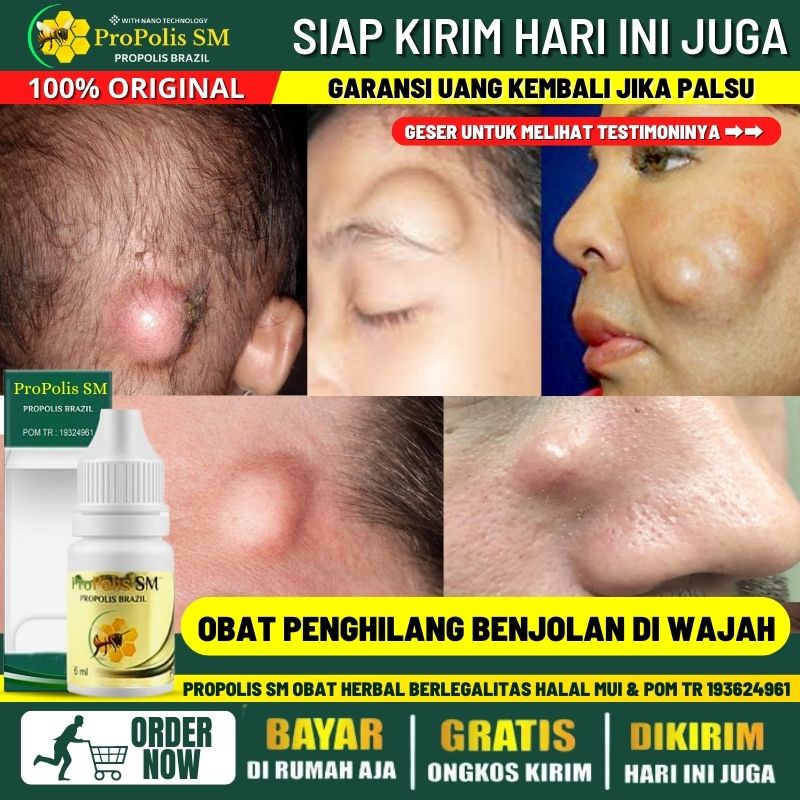 Jual Salep Penghilang Benjolan Abnormal Di Wajah Bisul Bernanah Di