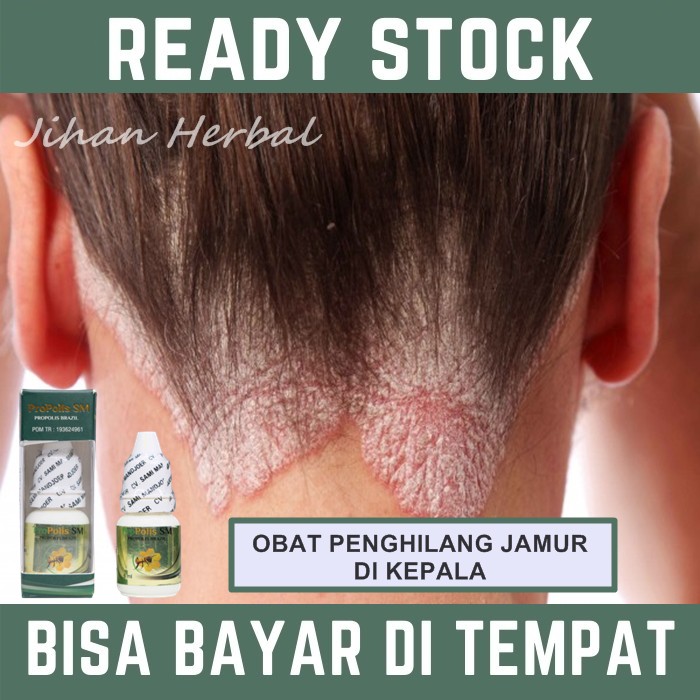 Obat Jamur Di Kepala, Kulit Kepala Berjamur, Gatal, Kulit Kepala Kurap & Bersisik | Propolis SM